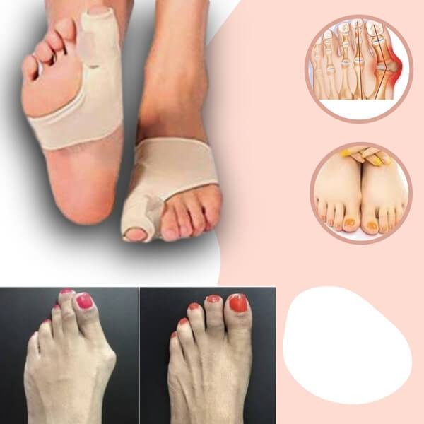 Διορθωτής για Κότσι (Hallux Valgus) και Ανακούφιση από τον Πόνο