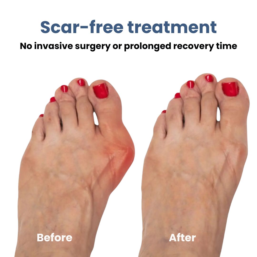 Νάρθηκας Διόρθωσης Κότσι (Hallux Valgus)
