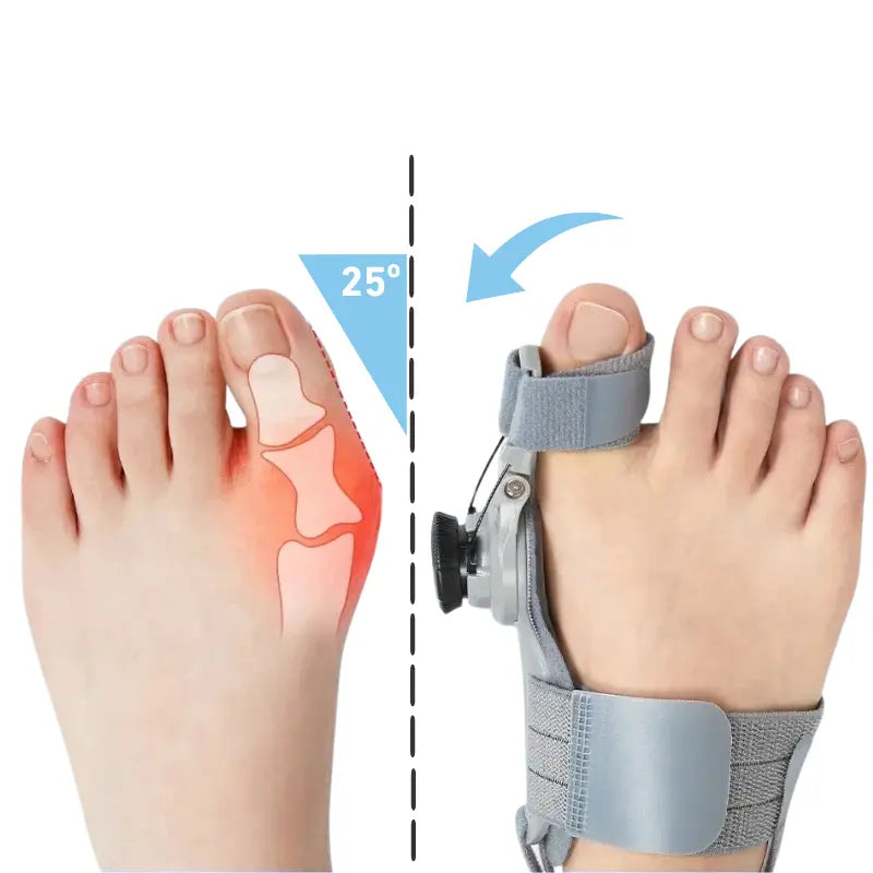 Νάρθηκας Διόρθωσης Κότσι (Hallux Valgus)